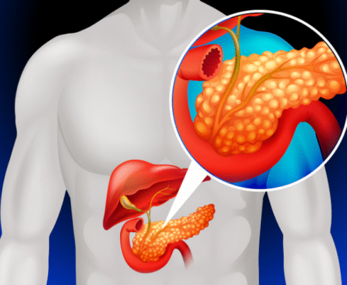 Pancreatic Cancer: Symptoms, Diagnosis & Advanced Treatment Options | Dr. Asit Arora