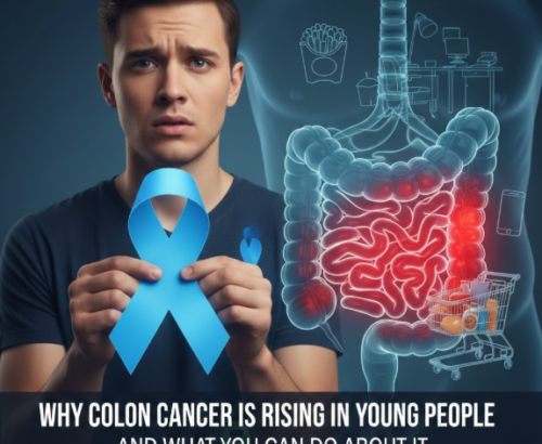 Colon Cancer Under 50