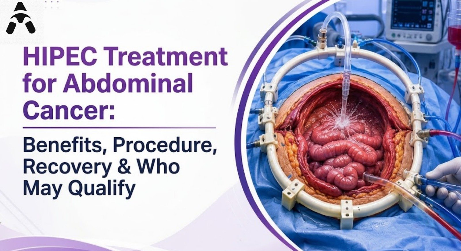 HIPEC Treatment in Delhi for Abdominal Cancer